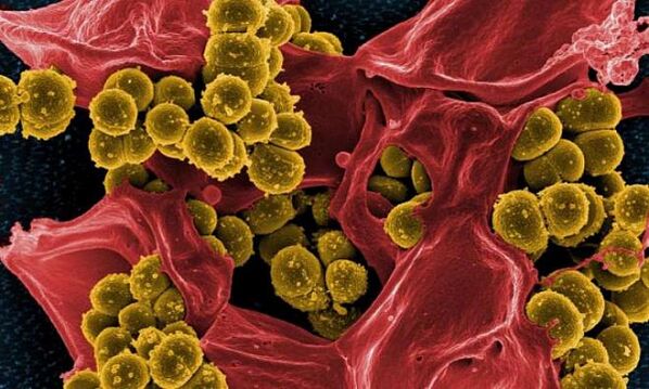 Staphylococcus aureus como causa de prostatitis bacteriana