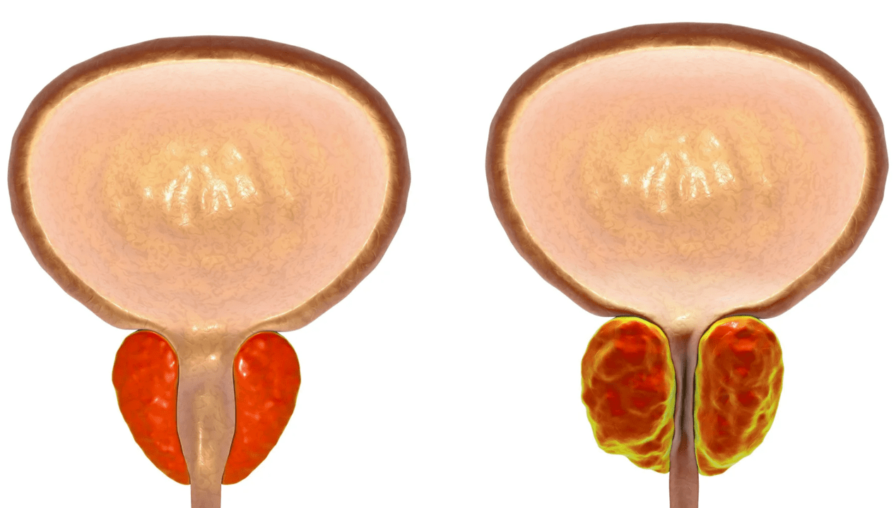 ¿Qué es la prostatitis