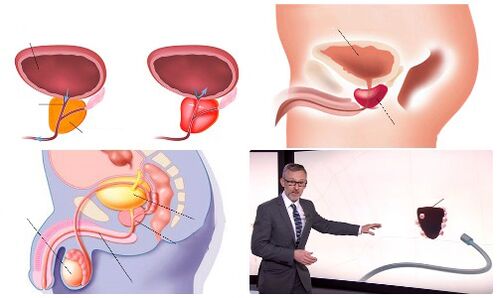 próstata sana y enferma